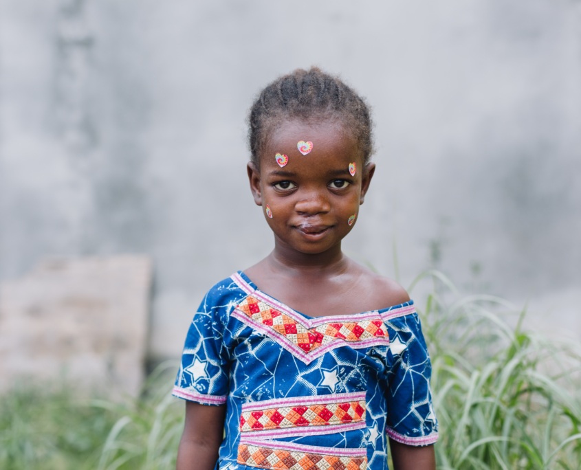 Aminata, Cleft Lip Patient, After Surgery.