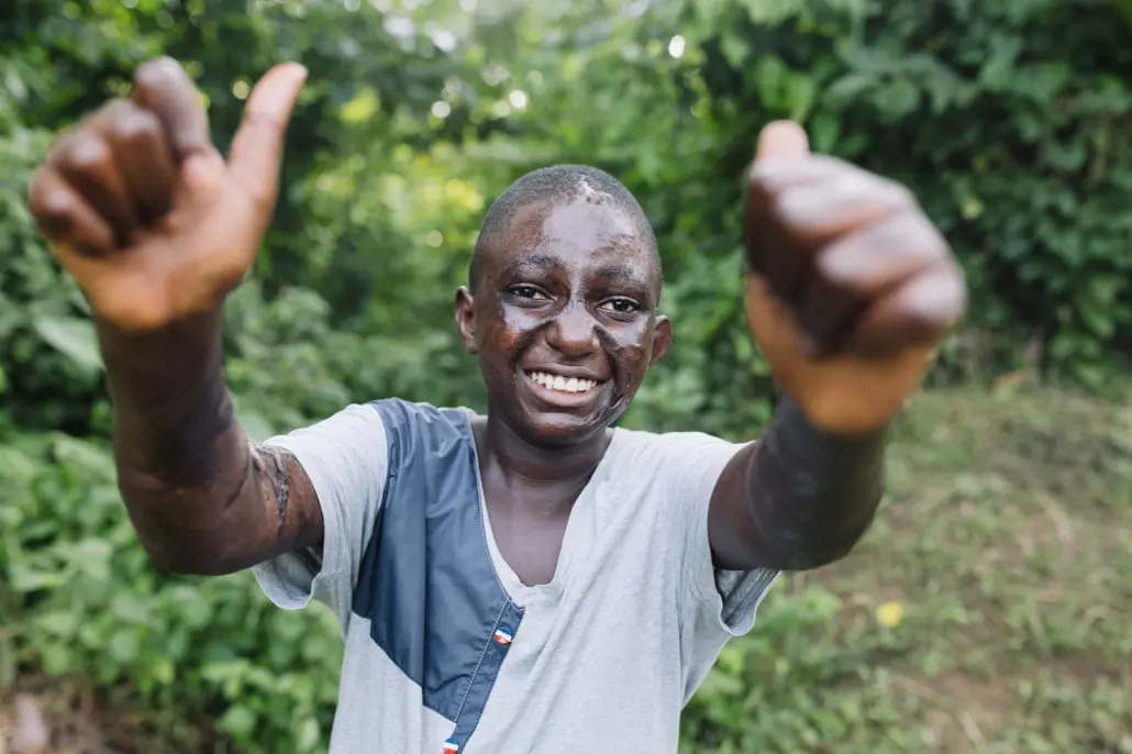 Paul Bernard, Plastics Patient, Outside His Home After Surgery.