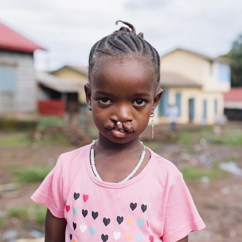 Aminata, een patiënt met een gespleten lip in haar roze hartjesshirt